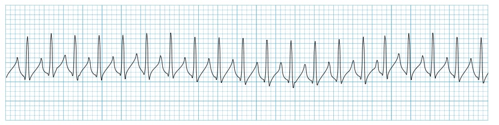 Supraventricular tachycardia (SVT) ecg readout