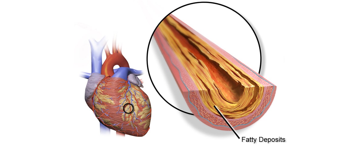 artist rendering of human blood vein with fatty deposits